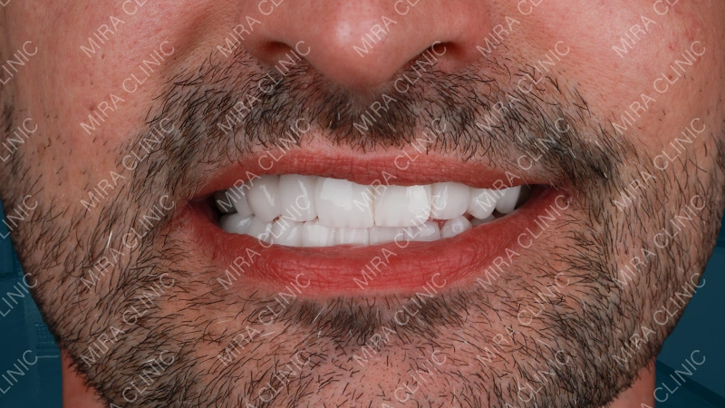 Hollywood smile before - after 